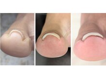 ペルシャ 坂戸駅前店(Persian)/巻き爪ケア施術しています♪