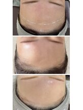 サロン ラン(salon rann)/face &nbsp;wax × UNSTRESS &nbsp;２回