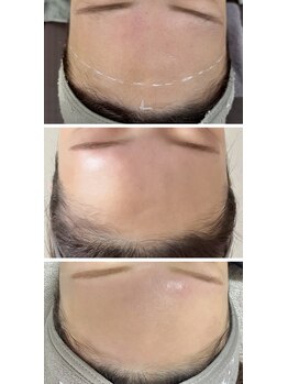 サロン ラン(salon rann)/face &nbsp;wax × UNSTRESS &nbsp;２回