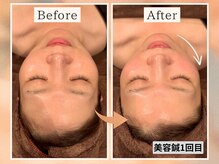 ハリキュア(H.a.r.i C.u.r.e.)の雰囲気(フェイシャルと鍼を融合した美容鍼♪噛み締め解消◎リフトUP↑)