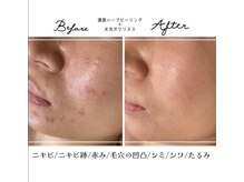 アリュール 倉敷(ALLURE)の雰囲気（人気No.1濃厚ハーブと水光ボツリヌスの組み合わせで早い改善に☆）