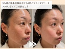 レイテノール 藤沢店の雰囲気（3か月の集中色素トラブルケア。40代スタッフの実症例です！）