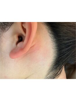 デリケート部分の脱毛/Vライン/VIO