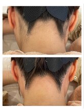 アイリス(Iris)/《before→after》うなじWAX