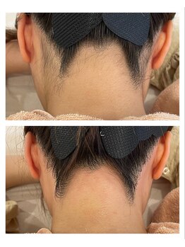 アイリス(Iris)/《before→after》うなじWAX