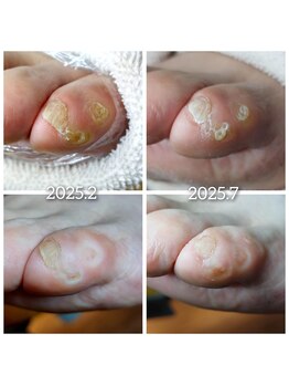 爪切り屋 足楽/【小指の魚の目】