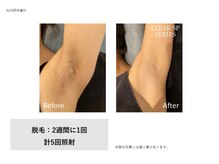 サロン ルアナ(salon luana)/わき脱毛　before→after