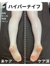 サロンイーエフ セントラル店(Salon EF)/ハイパーナイフ/脚
