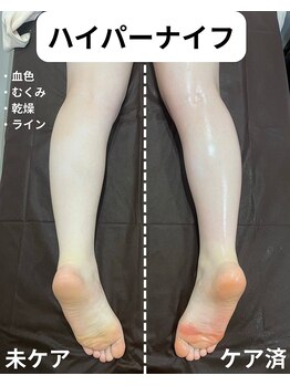 サロンイーエフ セントラル店(Salon EF)/ハイパーナイフ/脚