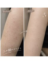 スキニティ 池袋(sknity)&nbsp;隠すの 卒業