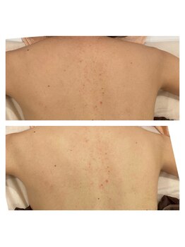 アイリス(Iris)/《before→after》背中WAX