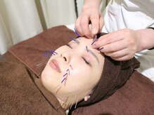 美リレア/大人気☆美容鍼