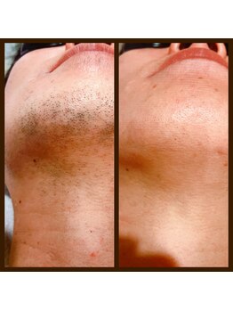 リアンジュ/ヒゲ脱毛の経過