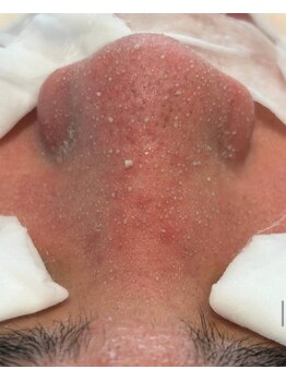 ルチル(Rutile)/韓国式3D毛穴洗浄