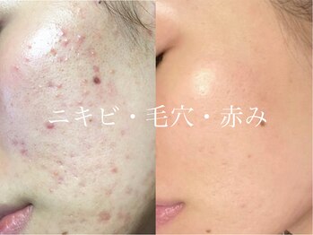 ビスキン(BeSkin)/ハーブピーリング(DT有)