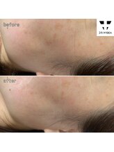 エミリー 守山(EMILY)/【症例写真】シミ取リ放題 (3)