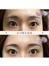 リバイセリー(Revicelly)/眼瞼下垂にも◎