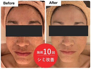 フワリ(fuwari)/施術10回★シミ改善顔のトーンUP
