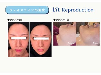 アニュー(anew.)/【Lit症例】フェイシャル