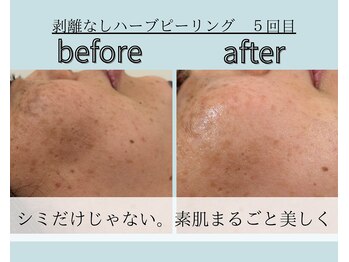 エレナ(ELENA)の写真/1点のシミより、肌全体の綺麗さを。剥離なしハーブピーリングで育てる透明肌