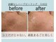 エレナ(ELENA)の写真/1点のシミより、肌全体の綺麗さを。剥離なしハーブピーリングで育てる透明肌