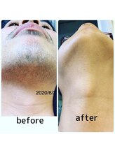 グランデ(GRANDE)/【あごした】ビフォーアフター