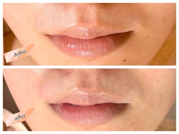 アイリス(Iris)/《before→after》口周りWAX