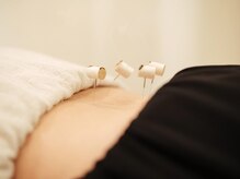 ジェイペック鍼灸整骨院/灸頭鍼【肩こり・腰痛に】