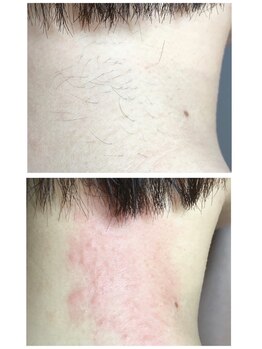 ダブルオー 銀座(00)/美容電気脱毛/うなじ脱毛