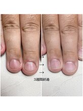 スマイルニコ(smile nico)/男性の深爪もok！