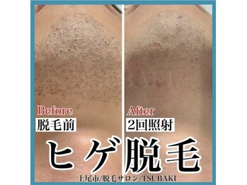 ツバキ(TSUBAKI)/ヒゲ脱毛