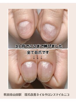 グラスネイル深爪矯正