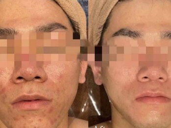 ブルーム(BLOOM)/最先端エステ機器　WISH PRO