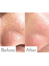 ヒカリエステ 六本木(HIKARI ESTHE)/ハイドラ＋ピーリング＋美容液