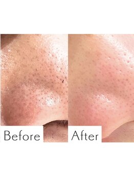 ヒカリエステ 六本木(HIKARI ESTHE)/ハイドラ＋ピーリング＋美容液