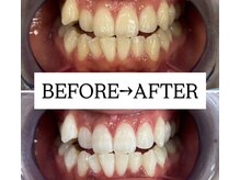 ホワイトニングサロン 宝塚/Before&After美白ホワイトニング