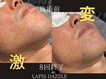 ラピスダズル(LAPIS DAZZLE)/ひげ脱毛★経過途中