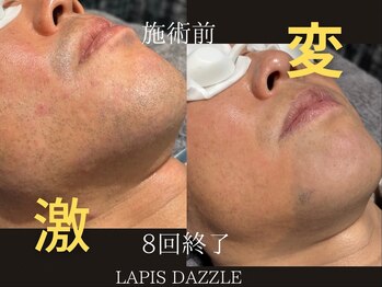 ラピスダズル(LAPIS DAZZLE)/ひげ脱毛★経過途中