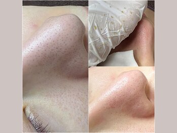 セリジェ 青山(Cerisier)/皮脂汚れや菌がたくさん！