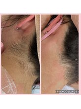 アイリス(Iris)/《before→after》うなじWAX