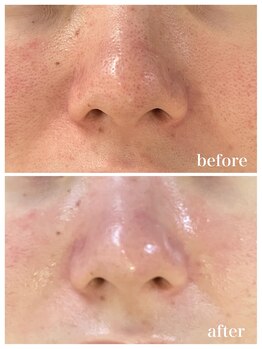 ジャスミン(Jasmin)/毛穴洗浄