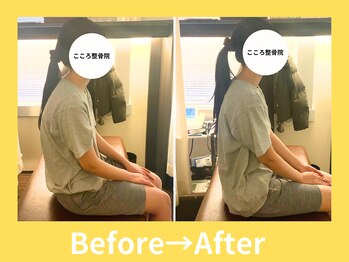 こころ整骨院/20代女性のビフォーアフター