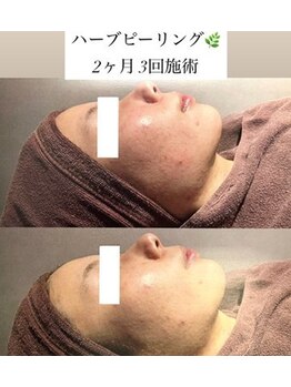 チャルム(CAL'ME)/ハーブピーリング