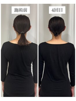 エクラ(eclat)/120分コース4回施術