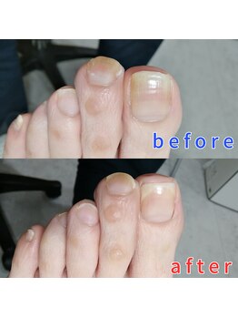 【トータルフットケア】/フット