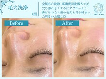 フローフシ∞/【毛穴洗浄】毛穴の黒ずみ改善