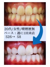 スマイルホワイト 赤羽店/ホワイトニングBefore After
