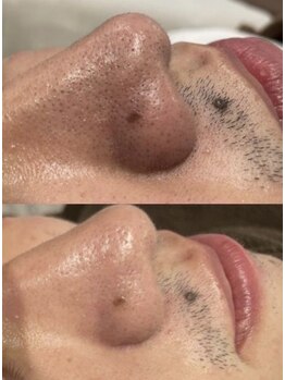 トータルエステサロン ポイント(POINT)の写真/毛穴の黒ずみや開きを徹底的に改善！お肌の汚れを取り除いてニキビケア◎透明感のある毛穴レスなツヤ肌に♪