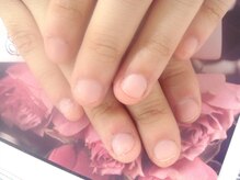 ネイルサロンひまわり/【噛み爪の修復】施術前の状態