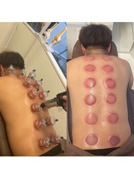 とるこり美姿整体院 新宿院/カッピング/老廃物/血行/こり